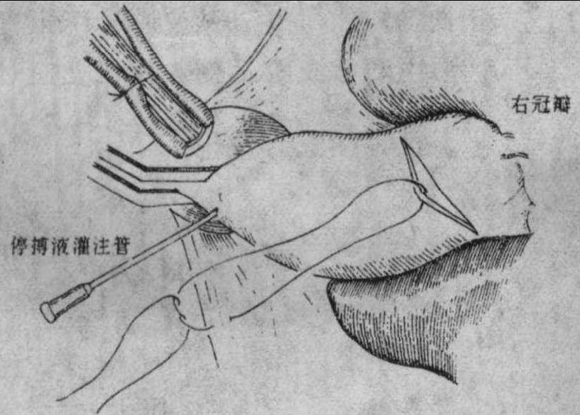 主動脈瓣交界切開術